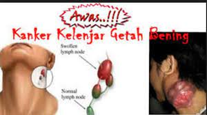 Kanker ini dapat menyebar dari tempat awalnya ke bagian lain dari tubuh. Mengenali Gejala Dan Makanan Penyebab Kanker Kelenjar Getah Bening Halaman All Tribun Pontianak