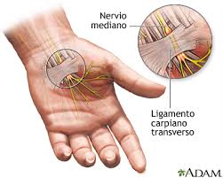 Sindrome Del Tunel Carpiano Medlineplus Enciclopedia Medica
