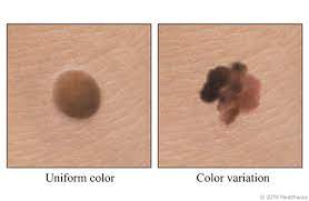 2 people of color have higher percentages of acral lentiginous melanoma (alm, melanoma of the palms, soles and nailbeds) than caucasians, whereas superficial spreading melanoma is the most frequent subtype in caucasians and hispanics. Melanoma Skin Cancer Sign Color Variation Orange County Health Care Agency California
