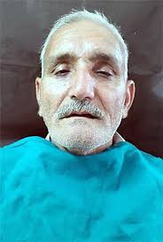 Figures index : Use of Base Metal/Alloy Denture Base In Parafunctional Oral  Habit