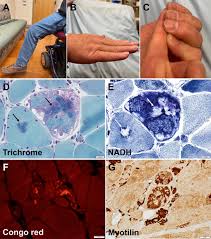 Image result for Myopathy