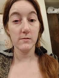 Serrano pepper oil causes eye burning