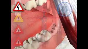 Our powerful toothpaste collection helps reverse early gum damage. Live Operation How The Wisdom Tooth Is Removed Youtube