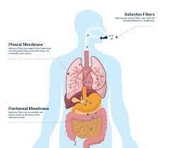 Check spelling or type a new query. What Causes Mesothelioma Cancer How You Get It Risk Factors