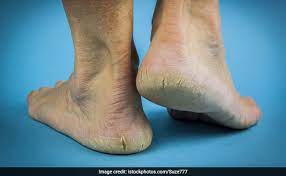 5 Effective Home Remedies For Cracked Heels Ndtv Food