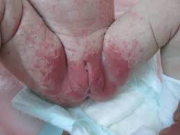 Image result for diaper dermatitis