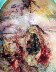 Pulmonar n6 (35%), diseminada n1 (5.8%), cerebral n1 (5.8%) peritoneal n1 (5.8%), cutanea n2 (11.7%); Https Www Researchgate Net Publication 323788966 Rhino Orbito Cerebral Mucormycosis From Dental Origin Case Report Fulltext 5aab2577aca272d39cd7acde 323788966 Rhino Orbito Cerebral Mucormycosis From Dental Origin Case Report Pdf Origin Publication Detail