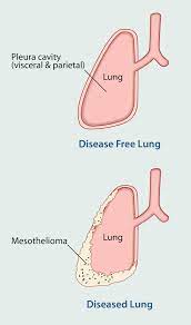 The death rates for the groups between the ages of 25 and 34 as well as the ages between 35 and 44 were both fewer than one death per million. Mesothelioma Symptoms Comprehensive Cancer Information Facts