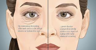 Private health insurance that covers cosmetic surgery. Eyelid Surgery Darien Ct Fairfield County Fredric Newman Md Facs