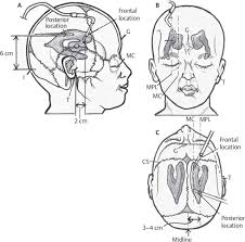 External Ventricular Drain Ventriculostomy Neupsy Key