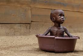 Image result for malnutrition symptoms