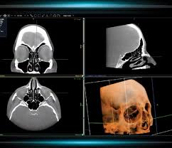 Image result for Sinus CT