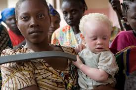 Maybe you would like to learn more about one of these? International Albinism Awareness Day United Nations