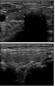 Graves' disease patients with eye problems can be treated with the biologic teprotumumab ( tepezza ). The Role Of Ultrasound In The Differential Diagnosis Of Hypothyroidism Intechopen