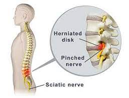 But what does that really mean? Pinched Nerve Radiculopathy Back Pain Neck Pain