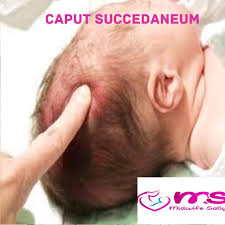 Image result for Vacuum Caput