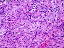 Epithelioid mesothelioma is the most common type of asbestos cancer. Webpathology Com A Collection Of Surgical Pathology Images