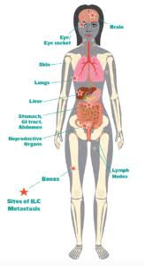 Frequently Asked Questions About Ilc The Lobular Breast Cancer Alliance