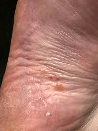 The most common type of infections that cause red spots on feet are athlete's foot fortunately, most causes of foot redness are benign and easily treatable, but some require evaluation and intervention by a medical professional. Small Red Spots Appear On My Feet Every Month Or Two Sometimes They Blister Sometimes They Become Hard Flaky Skin Never Itchy More Detail In Comments Diagnoseme