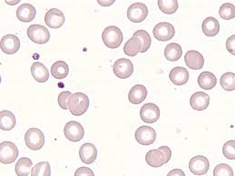 Sometimes, the condition doesn't cause any problems at all. Normale Thrombozyten Bildserie
