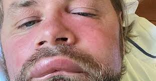 Brian McFadden suffers severe allergic reaction to bee sting