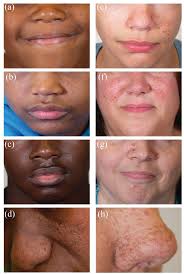 Facial angiofibromas in Black and White individuals with TSC. (a–d)...