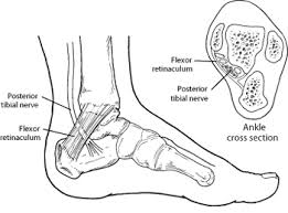 It attaches to the… … Tarsal Tunnel Syndrome Foot Health Facts