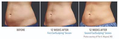 How long does coolsculpting last. When Will I See Results From Coolsculpting