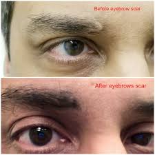 How to lighten tattooed eyebrows. Permanent Makeup Correction Eyebrows Tattoo Fix Cosmetic Tattoo Repair
