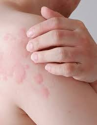 Image result for Hives