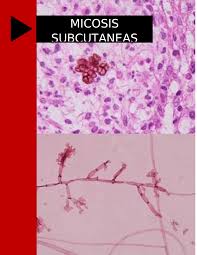 La mucormicosis es una infección rara con alta morbimortalidad causada por hongos invasivos. Monografia De Micosis Subcutanea Docsity