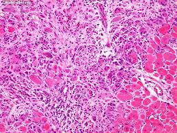 Management, and therapy of myocarditis: Webpathology Com A Collection Of Surgical Pathology Images
