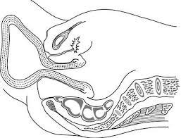 Image result for Uterine Inversion