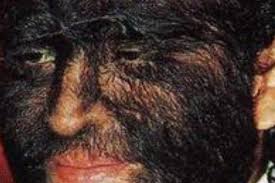 Image result for Hypertrichosis