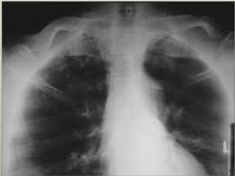 Articulated with the apex of the tongue touching or near the alveolar ridge , as ( t ), (. Radiology Chest Abd Midterm Practical Flashcards Quizlet