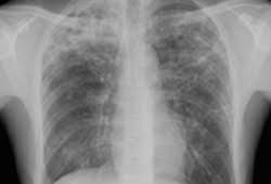 What does ptb stand for? Pulmonary Tuberculosis Symptoms Diagnosis And Treatment Bmj Best Practice Us