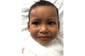 Child with second degree burns needs help for overseas treatment