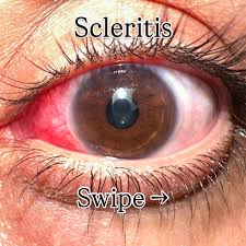 Image result for Scleritis
