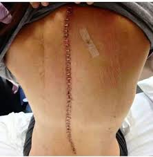 With the special tool that is commonly used. Surgical Staples