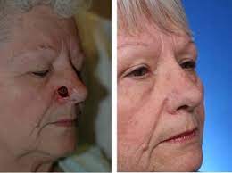 Understanding the symptoms and the risks associated with each type of skin cancer will help you determine the right course of treatment. Repairing The Nose After Skin Cancer In Just Eurekalert