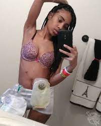 The Crohns Sufferer Whose Stoma Bag Was Ripped Off By Ignorant Security Guard Media Drum World