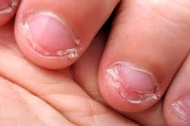 But most women go for long acrylics, can i get short acrylic nails then?. 5 Reasons To Stop Biting Your Nails Vital Record