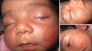 Ringworm Tinea Corporis Symptoms And Treatment Patient Ringworm sounds downright scary, conjuring images of creepy, crawly critters invading the skin. ringworm tinea corporis symptoms