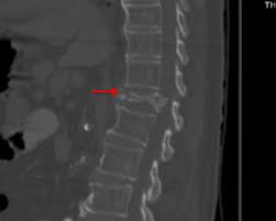 Image result for Vertebral Compression Fracture