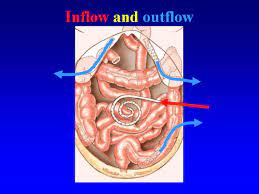 Asbestos fibers are believed to cause peritoneal mesothelioma when consumed and move through the digestive system to the gut. Hipec Ovhipec Pmp Peritoneal Cancer Peritoneum Seeding Seedings Metastases Hyperthermic Intraperitoneal Chemotherapy Debulking Colon Colorectal Ovarian Ovary Mesothelioma Pseudomyxoma Appendix