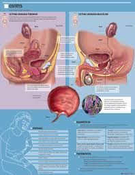 Cistitis Una Infeccion Intima Muy Recurrente Salud Ediciones