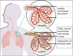 Learn the key differences between the two. Chronic Obstructive Pulmonary Disease Copd