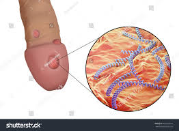 Image result for syphilis ulcer