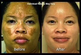 Pigmentation of the skin can occur just about anywhere on the body for a variety of reasons. Hyperpigmentation Scottsdale Skin Spot And Discoloration Treatments Phoenix Hyperpigmentation Treatments Arizona