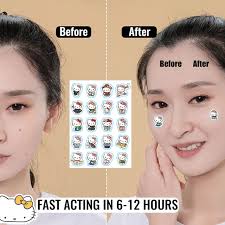 100pc Hello Kitty Cat Repair Acne Patch Facial Skin Care Fade Blemishes  Pimple Marks Closed Acne